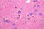 Alzheimer type II astrocyte hilighted.jpg